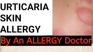 Urticaria Skin Allergy Reason Test Treatment Hives A to Z information in Hindi Dr Avyact [upl. by Merkley]