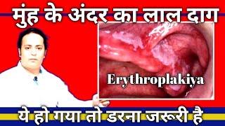 Is erythroplakia a cancer what are the symptoms of erythoplakia DrAmitkrDubey [upl. by Rolph668]