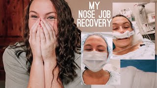 i got a nose job my recovery from septoplasty amp turbinoplasty ROUGH [upl. by Rossen]