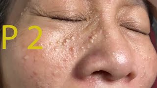 Make your Acne Treatment Huong Da Nang502  acne 2022 PArt 2 [upl. by Tristam149]