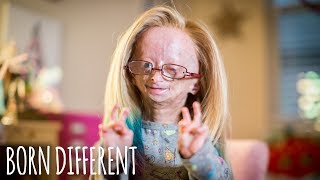 Adalia Rose The Girl Who Ages Too Fast  BORN DIFFERENT [upl. by Gaynor959]