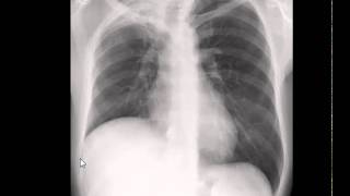 Chest xray interpretation Lung volume [upl. by Powers508]