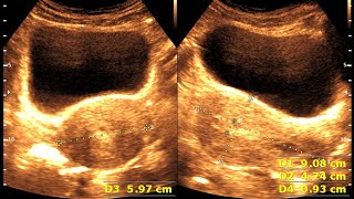 Ultrasound cases 13 of 2000  Retained product of conception [upl. by Hubey]