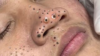 Big Cystic Acne Blackheads Extraction Blackheads amp Milia Whiteheads Removal Pimple Popping  6639 [upl. by Haleelahk985]