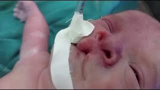 multiple congenital anomalies again in our nicu  drtmam [upl. by Peedus]