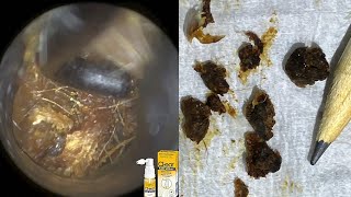 86  Completely Blocked amp Impacted Ear Wax Removal with WAXscope®️ [upl. by Eniluj]