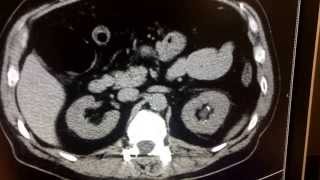 CT scan for kidney stone [upl. by Novah]