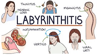 Understanding Labyrinthitis [upl. by Lecrad]