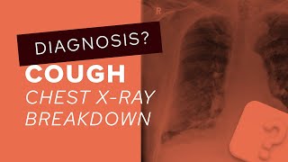 Chest XRay breakdown assessing a film with pleural plaques [upl. by Mun27]