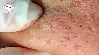 Acne facial removal treatment by Sopheaskincare 29th October 2023 [upl. by Rehpotsirhcnhoj512]