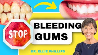 How To QUICKLY Treat Gingivitis and Bleeding Gums [upl. by Namrac78]