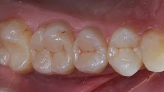 Реставрация и эндодонтическое лечение боковых зубов Resto amp Endo of posterior teeth [upl. by Aruasor]