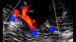 INTRACRANIAL ARTERY STENOSIS [upl. by Enenaej]