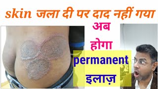 Fungal infection permanent treatment I Daad ka ilaj l Skin Care Clinic l Dr ANIL MOHITE l MD [upl. by Ecnahoy]