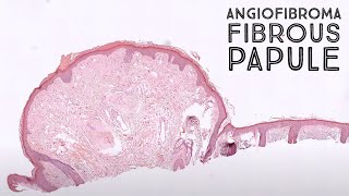 Angiofibroma fibrous papule clinical mimic of basal cell carcinoma pathology dermatology [upl. by Nehgam]