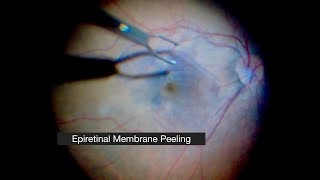 Vitrectomy for Epiretinal Membrane  Tijuana Baja California Mexico [upl. by Cindi]