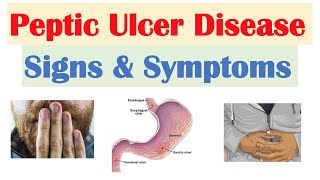 Peptic Ulcer Disease Signs amp Symptoms  Gastric vs Duodenal Ulcers [upl. by Barth915]