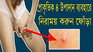 প্রাকৃতিক ৪ উপাদান ব্যবহারে নিরাময় করুন ফোঁড়া  Bangla Health Tips [upl. by Gruchot]