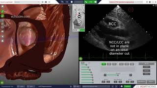 LVOT Measurement [upl. by Halas]