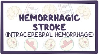 Hemorrhagic stroke intracerebral hemorrhage  causes symptoms diagnosis treatment pathology [upl. by Toney862]