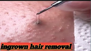 ingrown hair removal 😌 purifiedvideos viral [upl. by Isiahi603]