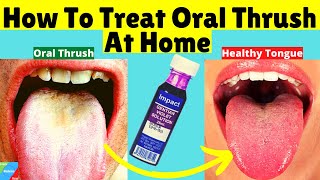 How To Treat Oral Thrush At Home  How to Treat Candida at Home [upl. by Harlow]