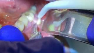 Draining a Dental Abscess  Advanced Dental Care [upl. by Eylrahc]