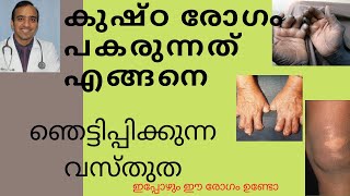 കുഷ്ഠരോഗം പകരുന്നത് എങ്ങനെ how does leprosy spreadmalayalam talk with English subtitlesDrsujith [upl. by Rozalin225]