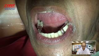 48Correção estética em dente metálico Veneer Dr Antônio Sérgio F Freitas [upl. by Acirre]