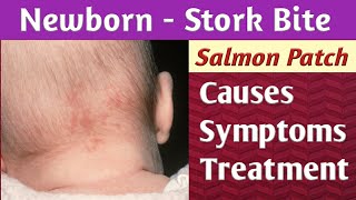 Newborn Stork Bite Salmon Patch Causes Symptoms Diagnosis amp Treatment [upl. by Washburn150]