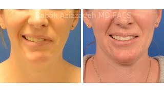 Bells Palsy Surgery Before amp After  Selective Neurolysis [upl. by Bab132]