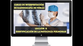 CURSO DE INTERPRETACIÓN DE RADIOGRAFÍA DE TÓRAX IDENTIFICACIÓN DE ENFERMEDADES PULMONARES [upl. by Vitalis]