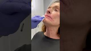 Botox for platysmal bands in the neck [upl. by Fields453]