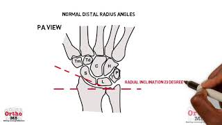 Radiographic features  Normal distal radius angles [upl. by Droc]