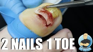 UNBELIEVABLE FUSED TOENAIL REMOVAL [upl. by Aicinad327]