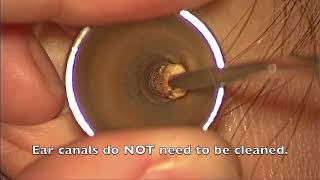 Ear Wax Extraction  St Pauls Hospital [upl. by Isis]