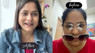 Cholesterol deposit surgery me kitna paisa laga  Xanthelasma Removal Surgery Before amp After [upl. by Ajed]