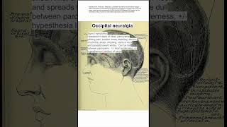 Occipital neuralgia [upl. by Mallis]