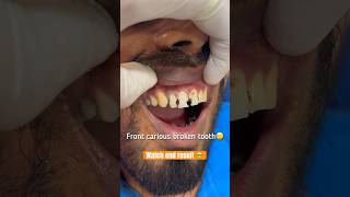 Repairing treatment of front broken incisors Root canal treatment Dental filling viral video [upl. by Tlok]