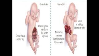 Omphalocele vs Gastroschisis [upl. by Lua260]