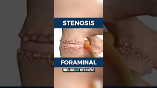 What is foraminal stenosis [upl. by Nivad881]