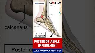 Struggling with persistent pain at the back of your ankle 🤔  physiotherapy ankleinjury [upl. by Siraf]