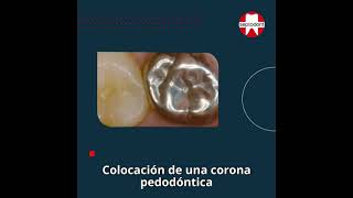 Pulpotomia con Biodentine  Caso clinico de la Lucile Goupy [upl. by Giffie]