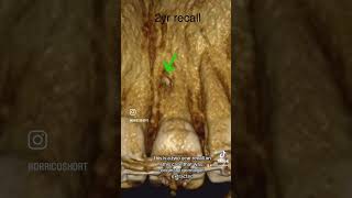 Large Lateral Canal Mimicking VRF 🦷 [upl. by Ellitnahc]