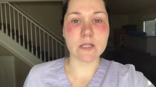 Aveeno moisturizer burnt my skin [upl. by Il]