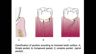 Periodontal Pocket Dr Enas Elgendy [upl. by Lissner55]