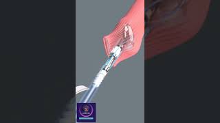 Laparoscopic Esophageal Surgery [upl. by Luo376]