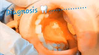 What is your diagnosis8 White patch extending on hard palate premalignant keratotic lesions [upl. by Alisia371]