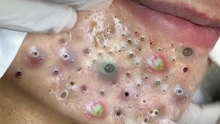 Big Cystic Acne Blackheads Extraction Blackheads amp Milia Whiteheads Removal Pimple Popping  2540 [upl. by Wilfrid503]