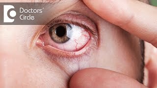 What causes visible red fine lines in eyes  Dr Elankumaran P [upl. by Tsnre]